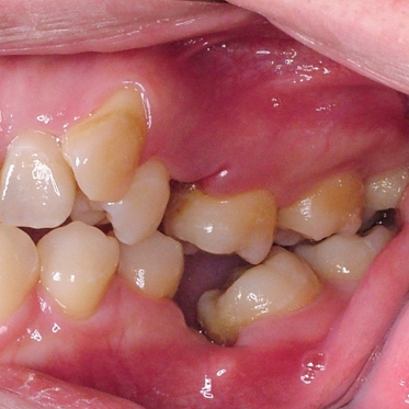 長期缺牙,牙亂