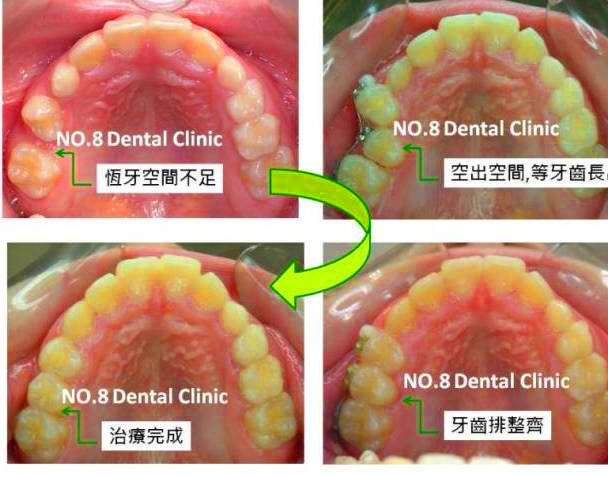 恒牙生长空间不足