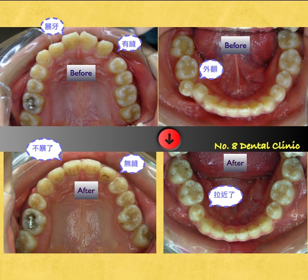 矯正前後口內比較