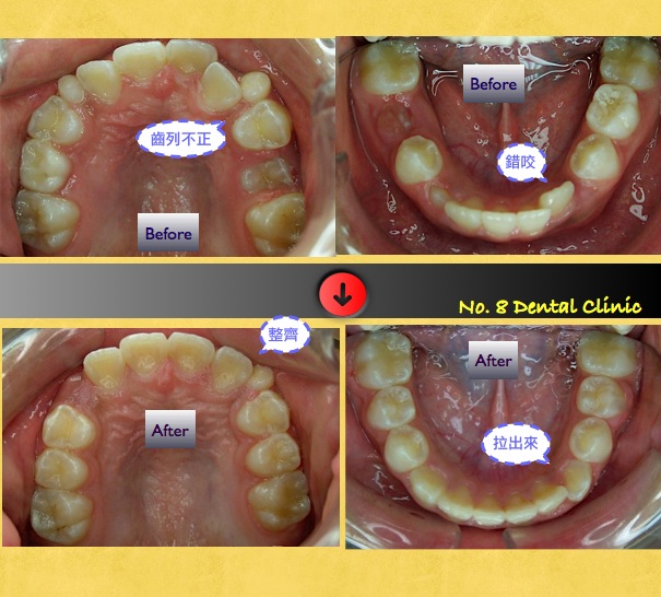 矯正前後口內比較