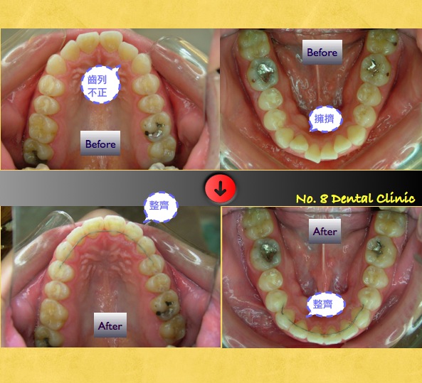 矯正前後口內比較