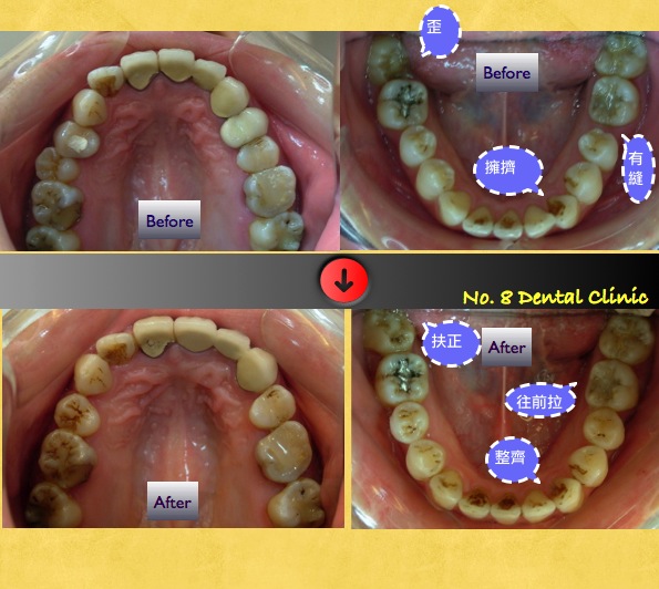 矯正前後口內比較