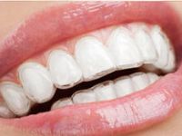 配戴隱形牙套，該如何維持口腔衛生？